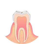 歯の表面に虫歯ができる