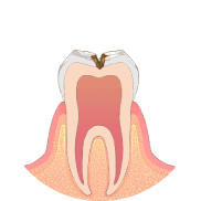 虫歯が神経に近くなり、冷たいものがしみる