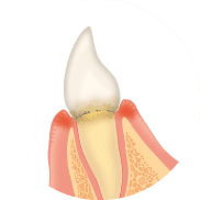 歯と歯ぐきの間に歯垢がたまります