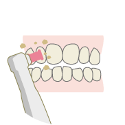 歯のクリーニングと自宅での使用法説明