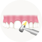 歯間や歯面をクリーニング