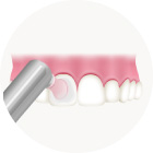 歯の表面をツルツルに仕上げ磨き